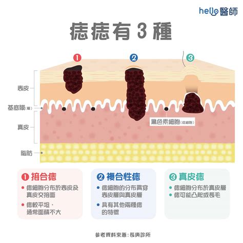 臉上的痣長毛|痣形成的原因？痣長毛、痣變多變大是痣病變？5招判。